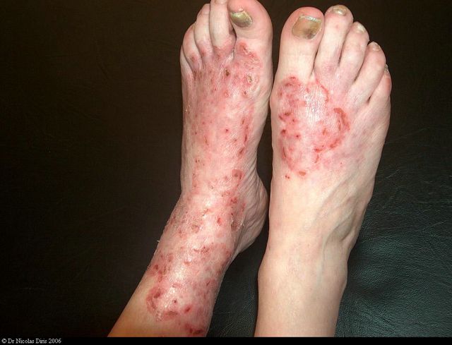 dermatose des pieds